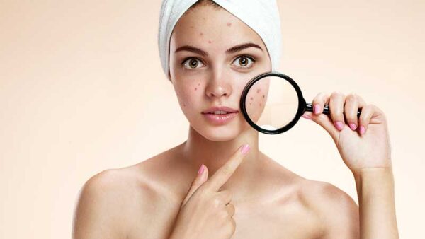 Acne da cosmetici. Quando i cosmetici possono scatenare l'acne