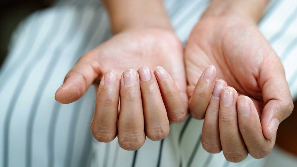Brittle nail. Quando le unghie sono fragili