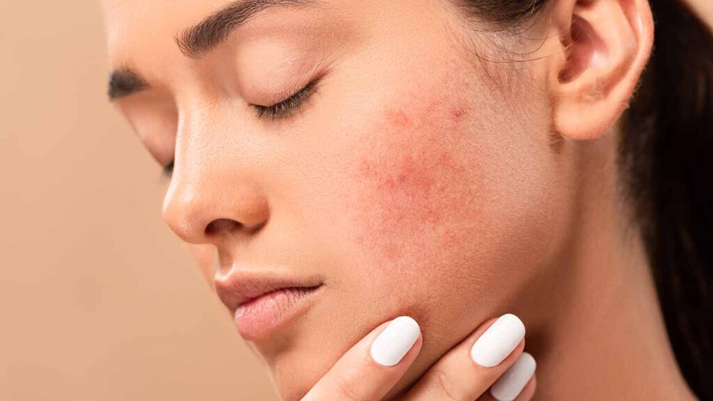 Il laser per il ringiovanimento cutaneo  e contro le cicatrici da acne e le smagliature